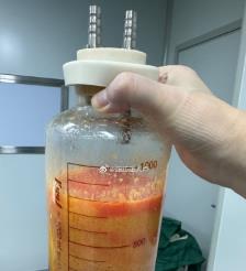 金坛水动力吸脂手术要做多久？